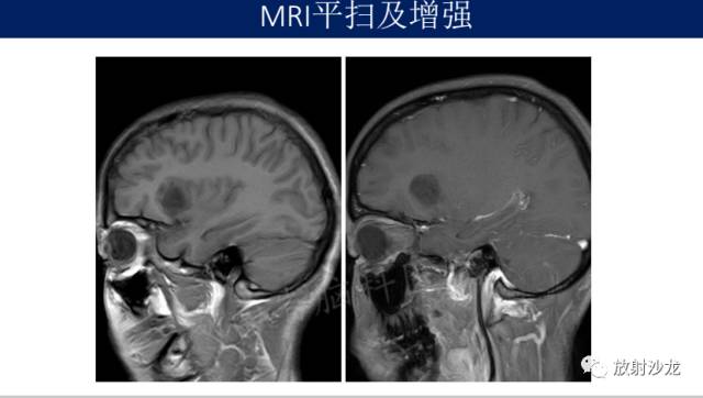 【病例】II级星形细胞瘤1例MR影像表现