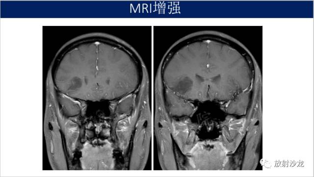 【病例】II级星形细胞瘤1例MR影像表现