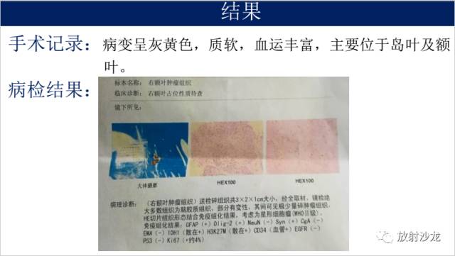 【病例】II级星形细胞瘤1例MR影像表现