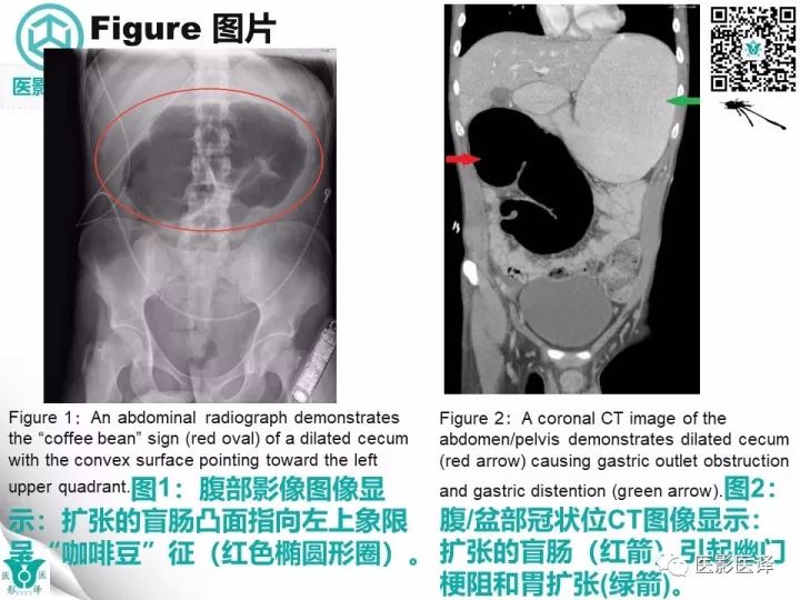 【病例】盲肠扭转伴幽门梗阻1例X线CT影像表现