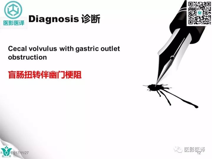 【病例】盲肠扭转伴幽门梗阻1例X线CT影像表现