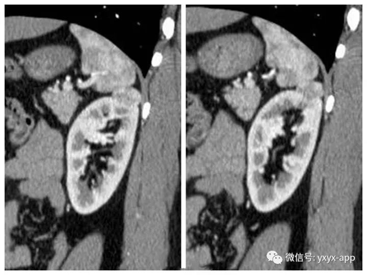 【病例】肾癌OR血管平滑肌脂肪瘤1例