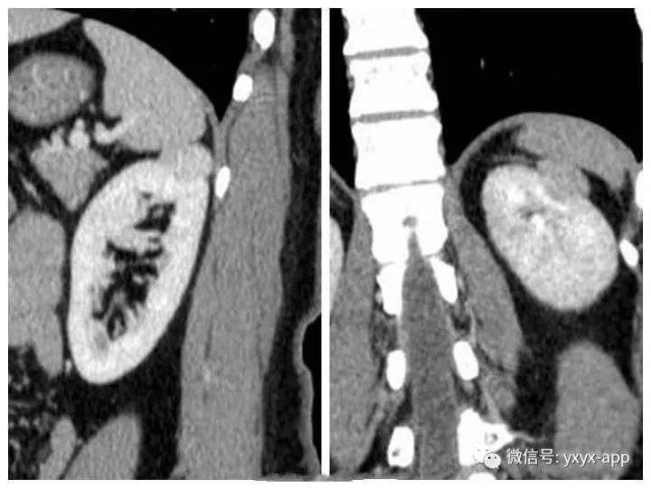 【病例】肾癌OR血管平滑肌脂肪瘤1例