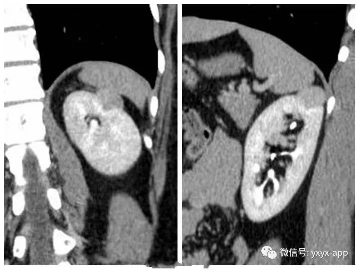 【病例】肾癌OR血管平滑肌脂肪瘤1例