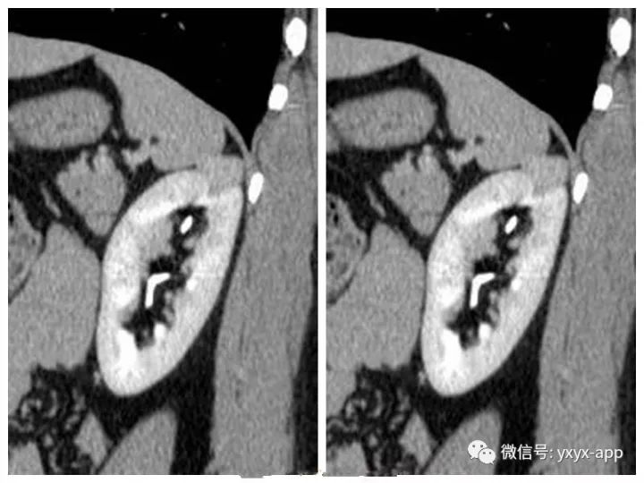 【病例】肾癌OR血管平滑肌脂肪瘤1例