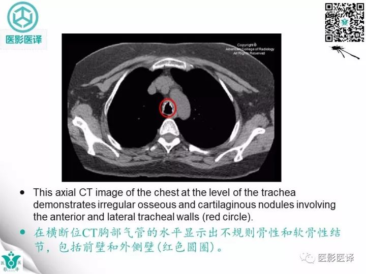 【病例】骨化性气管支气管病1例CT影像表现