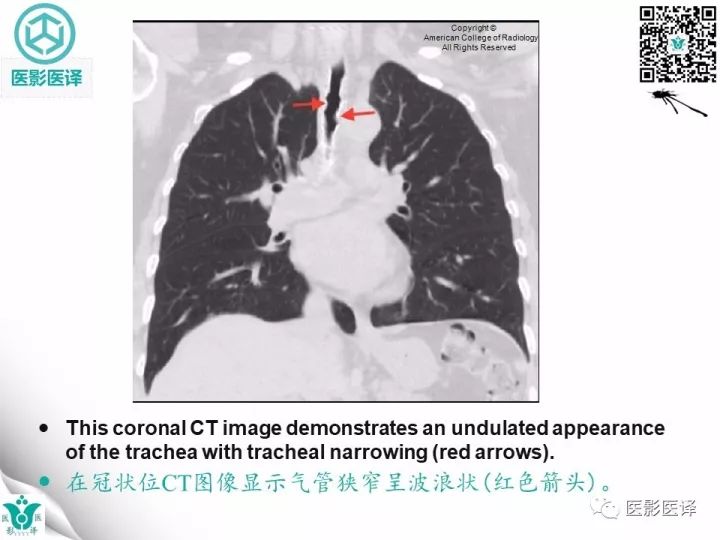 【病例】骨化性气管支气管病1例CT影像表现