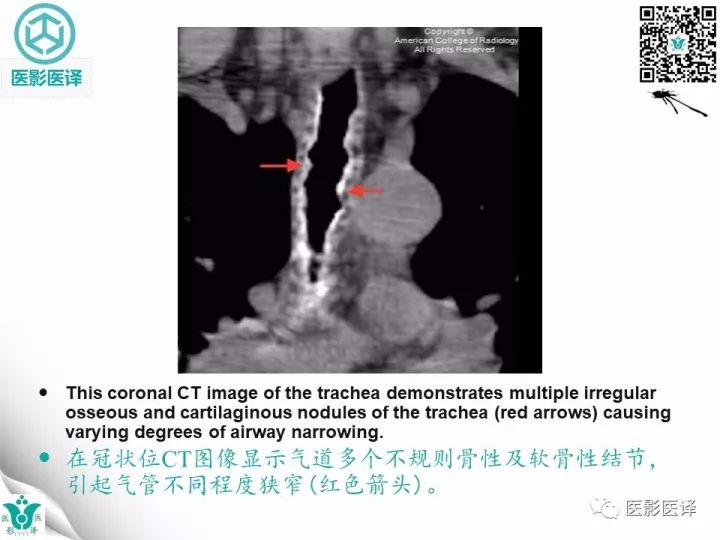 【病例】骨化性气管支气管病1例CT影像表现