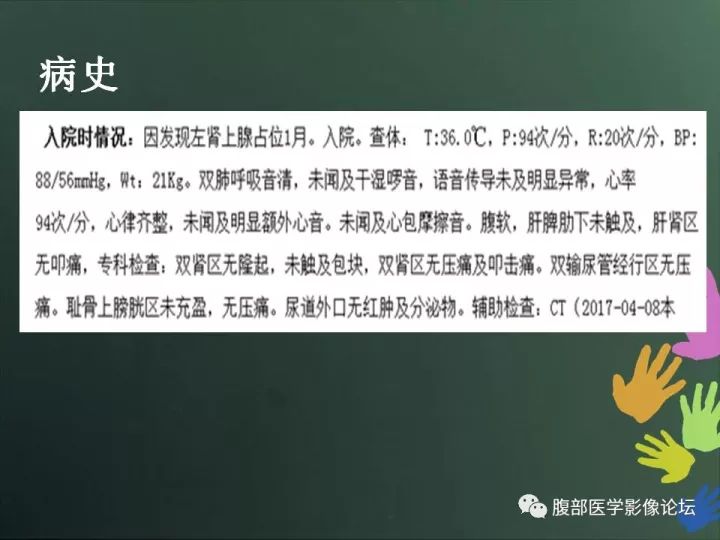 【病例】肾上腺神经节细胞瘤1例CT影像表现
