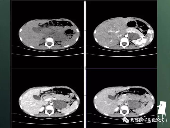 【病例】肾上腺神经节细胞瘤1例CT影像表现 【病例】肾上腺神经节细胞瘤1例CT影像表现