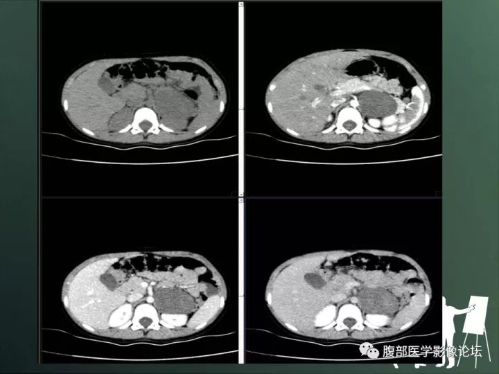【病例】肾上腺神经节细胞瘤1例CT影像表现 【病例】肾上腺神经节细胞瘤1例CT影像表现