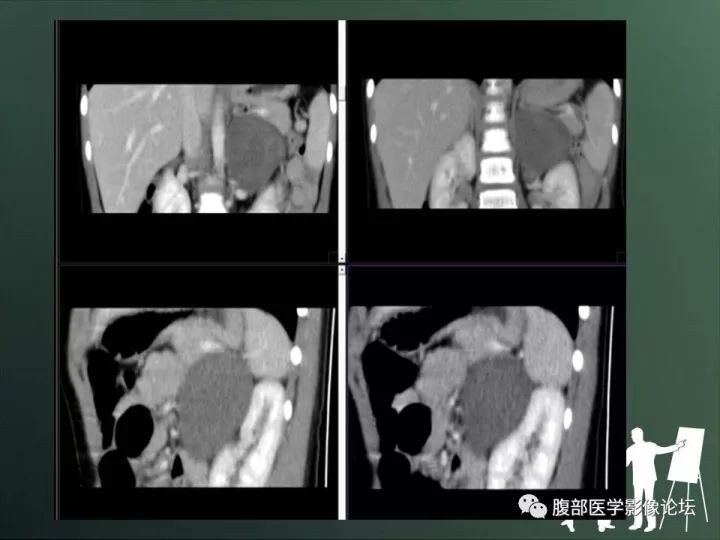 【病例】肾上腺神经节细胞瘤1例CT影像表现 【病例】肾上腺神经节细胞瘤1例CT影像表现