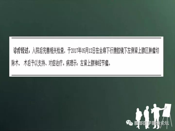 【病例】肾上腺神经节细胞瘤1例CT影像表现 【病例】肾上腺神经节细胞瘤1例CT影像表现