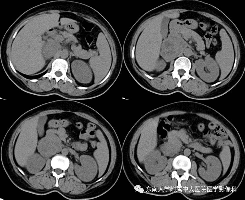 【病例】肾上腺嗜铬细胞瘤1例CT影像表现