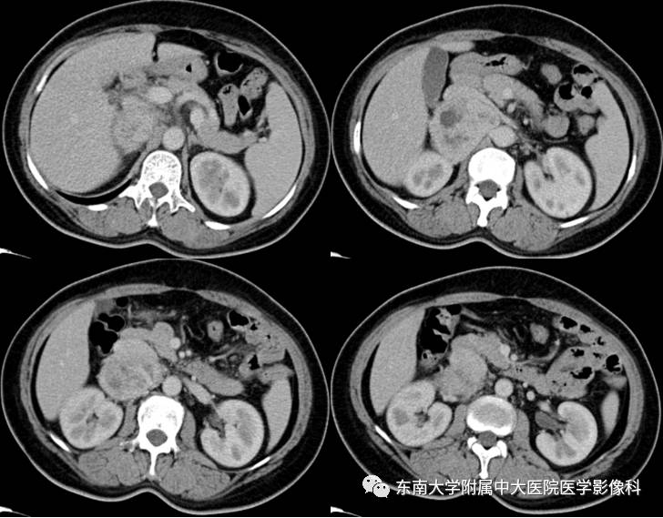 【病例】肾上腺嗜铬细胞瘤1例CT影像表现