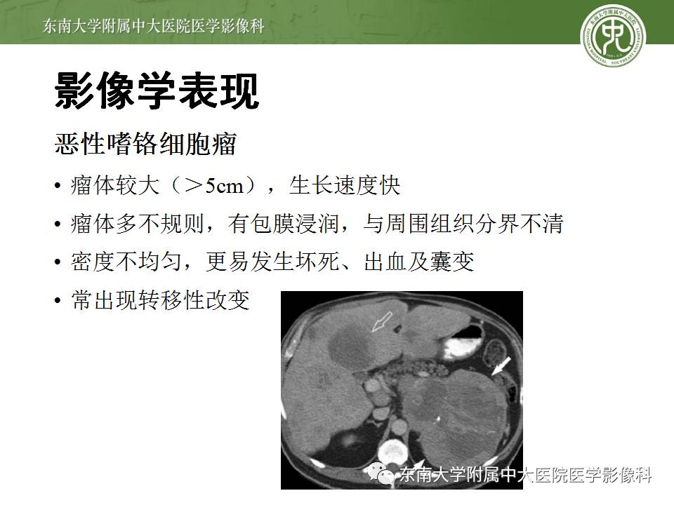 【病例】肾上腺嗜铬细胞瘤1例CT影像表现