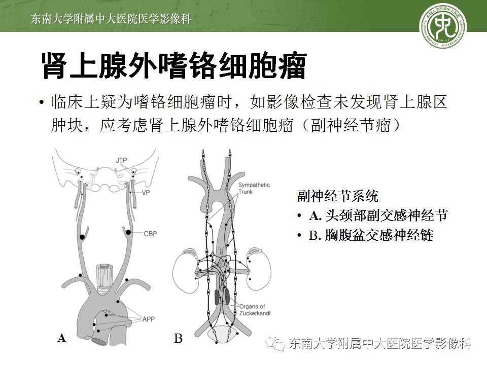 【病例】肾上腺嗜铬细胞瘤1例CT影像表现