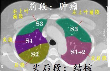 CT诊断肺结核宝典:这是我见过的最好的经验总结 CT诊断肺结核宝典:这是我见过的最好的经验总结
