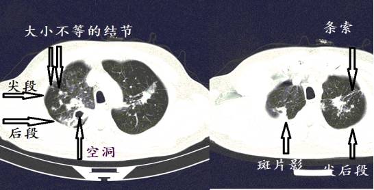 CT诊断肺结核宝典:这是我见过的最好的经验总结 CT诊断肺结核宝典:这是我见过的最好的经验总结