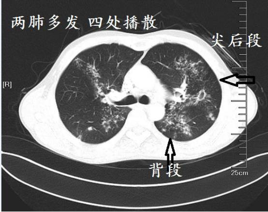 CT诊断肺结核宝典:这是我见过的最好的经验总结 CT诊断肺结核宝典:这是我见过的最好的经验总结