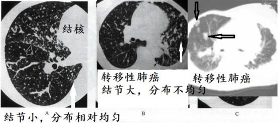 CT诊断肺结核宝典:这是我见过的最好的经验总结 CT诊断肺结核宝典:这是我见过的最好的经验总结