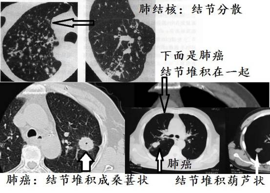 CT诊断肺结核宝典:这是我见过的最好的经验总结 CT诊断肺结核宝典:这是我见过的最好的经验总结