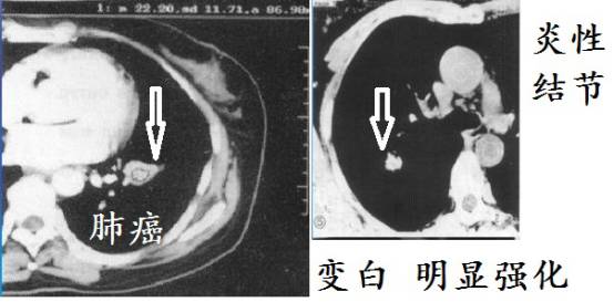 CT诊断肺结核宝典:这是我见过的最好的经验总结 CT诊断肺结核宝典:这是我见过的最好的经验总结