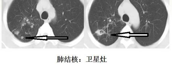 CT诊断肺结核宝典:这是我见过的最好的经验总结 CT诊断肺结核宝典:这是我见过的最好的经验总结