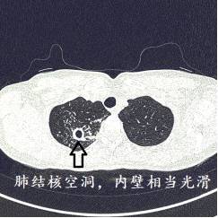 CT诊断肺结核宝典:这是我见过的最好的经验总结 CT诊断肺结核宝典:这是我见过的最好的经验总结
