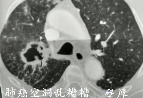 CT诊断肺结核宝典:这是我见过的最好的经验总结 CT诊断肺结核宝典:这是我见过的最好的经验总结