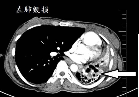 CT诊断肺结核宝典:这是我见过的最好的经验总结 CT诊断肺结核宝典:这是我见过的最好的经验总结