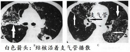 CT诊断肺结核宝典:这是我见过的最好的经验总结 CT诊断肺结核宝典:这是我见过的最好的经验总结