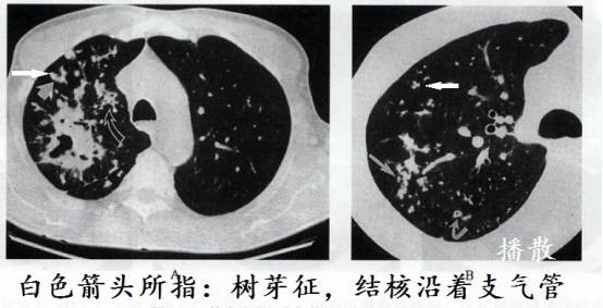 CT诊断肺结核宝典:这是我见过的最好的经验总结 CT诊断肺结核宝典:这是我见过的最好的经验总结
