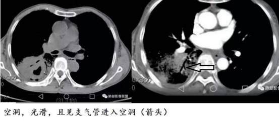 CT诊断肺结核宝典:这是我见过的最好的经验总结 CT诊断肺结核宝典:这是我见过的最好的经验总结