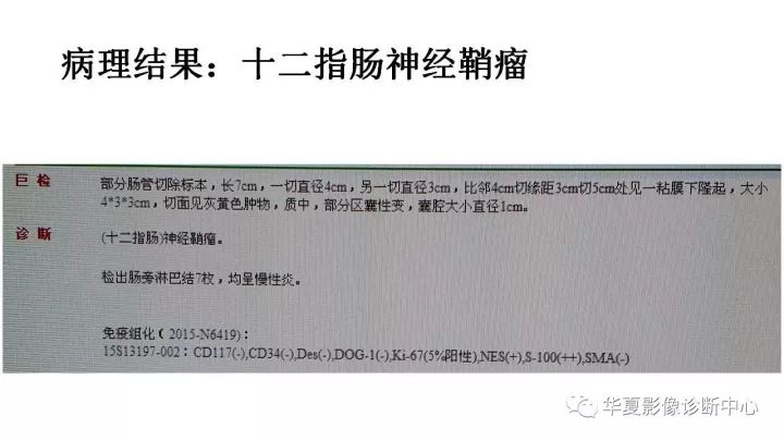【病例】十二指肠神经鞘瘤1例CT影像表现