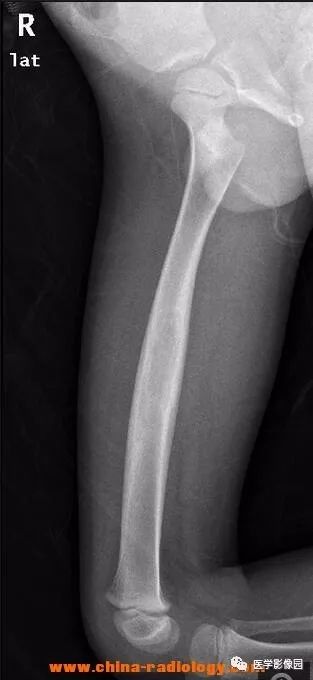 【病例】双侧股骨嗜酸性肉芽肿X线MR影像表现 【病例】双侧股骨嗜酸性肉芽肿X线MR影像表现