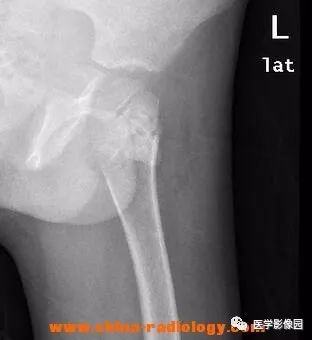【病例】双侧股骨嗜酸性肉芽肿X线MR影像表现 【病例】双侧股骨嗜酸性肉芽肿X线MR影像表现