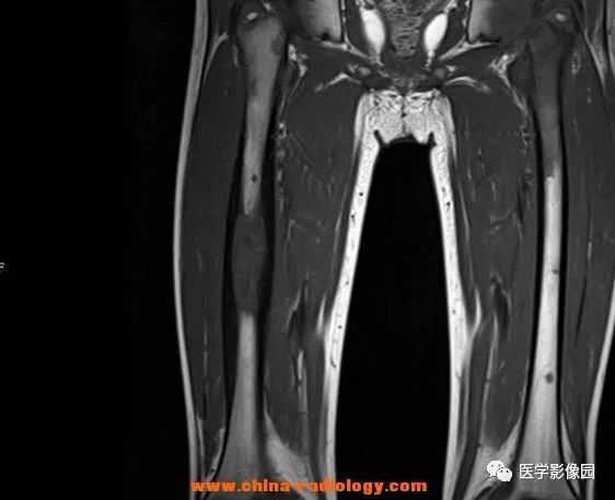 【病例】双侧股骨嗜酸性肉芽肿X线MR影像表现 【病例】双侧股骨嗜酸性肉芽肿X线MR影像表现