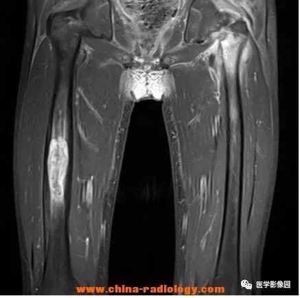 【病例】双侧股骨嗜酸性肉芽肿X线MR影像表现 【病例】双侧股骨嗜酸性肉芽肿X线MR影像表现