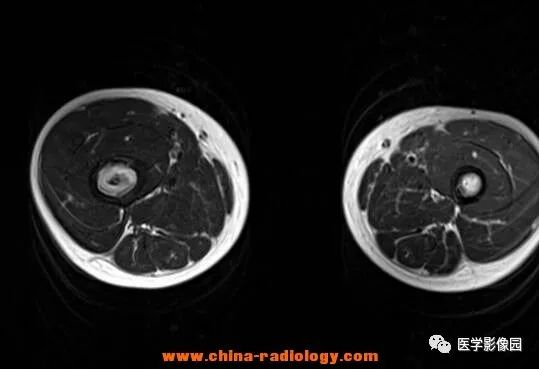 【病例】双侧股骨嗜酸性肉芽肿X线MR影像表现 【病例】双侧股骨嗜酸性肉芽肿X线MR影像表现