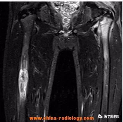【病例】双侧股骨嗜酸性肉芽肿X线MR影像表现