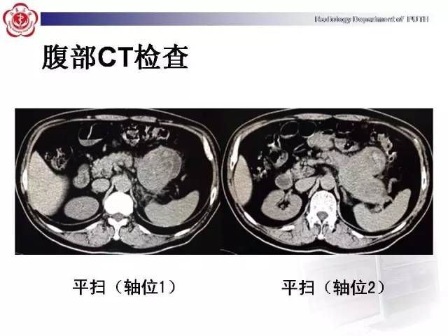 【病例】胰腺腺泡细胞癌1例CT影像表现