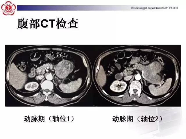 【病例】胰腺腺泡细胞癌1例CT影像表现