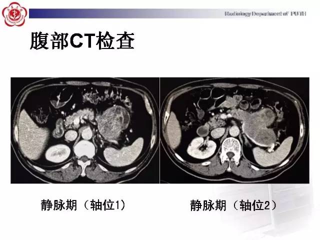 【病例】胰腺腺泡细胞癌1例CT影像表现