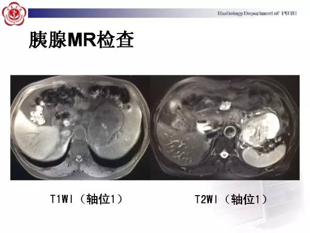 【病例】胰腺腺泡细胞癌1例CT影像表现