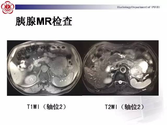 【病例】胰腺腺泡细胞癌1例CT影像表现