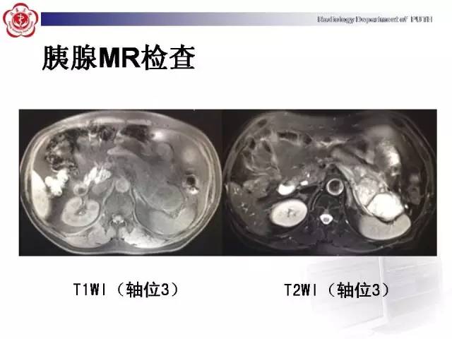 【病例】胰腺腺泡细胞癌1例CT影像表现