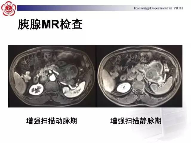 【病例】胰腺腺泡细胞癌1例CT影像表现