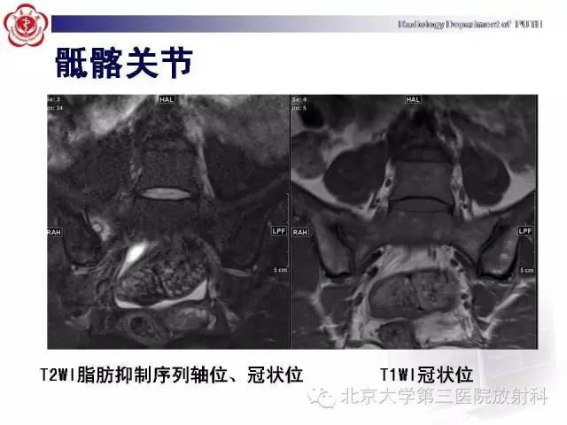 【病例】骨关节结核1例X线CT及MR一例影像表现