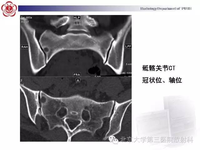 【病例】骨关节结核1例X线CT及MR一例影像表现